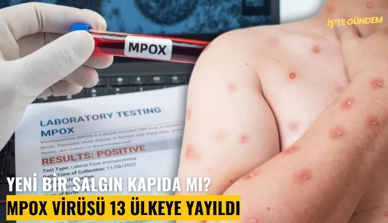 Yeni bir salgın kapıda mı? Mpox virüsü 13 ülkeye yayıldı